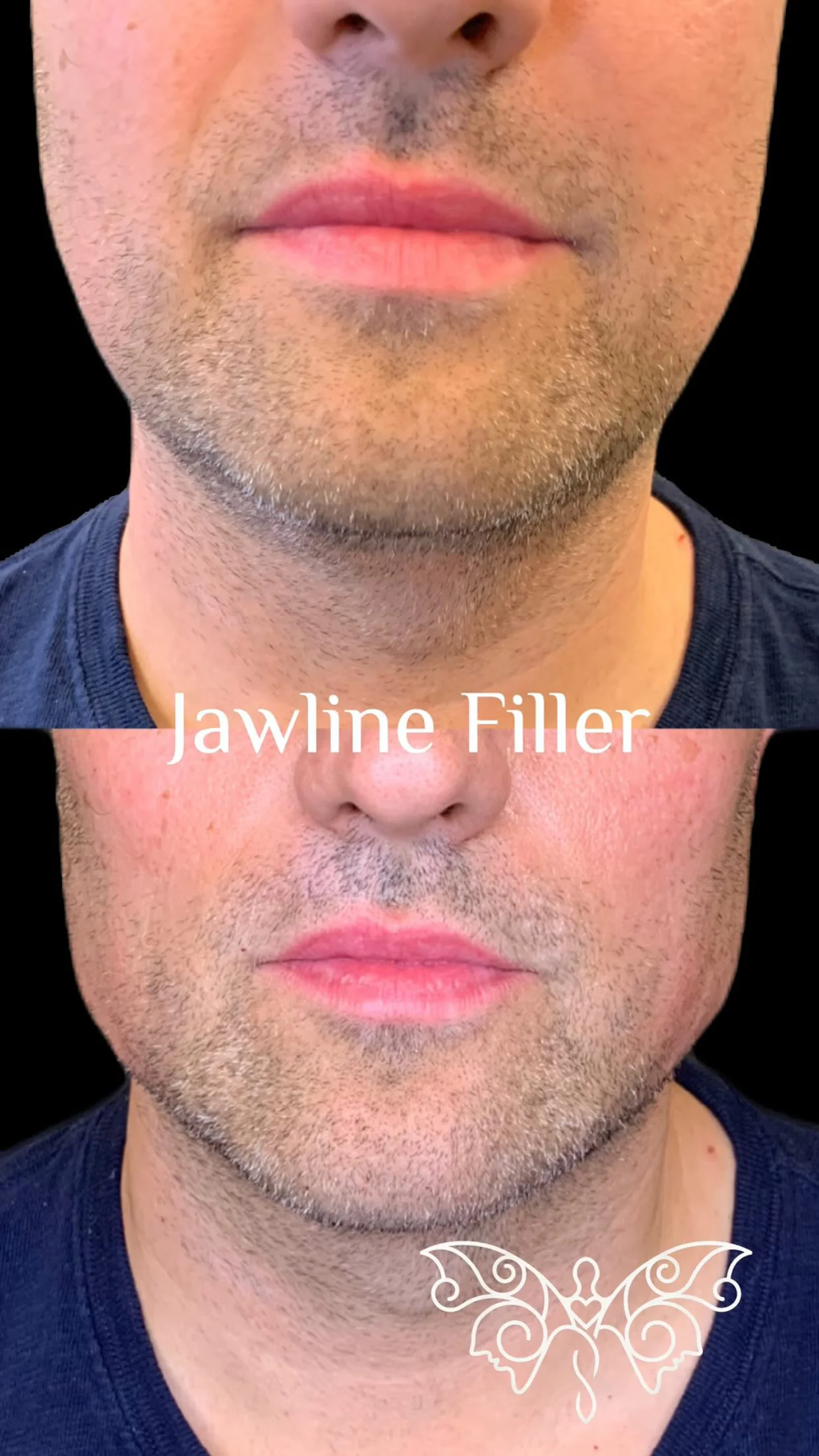 Before and After Jawline Filler