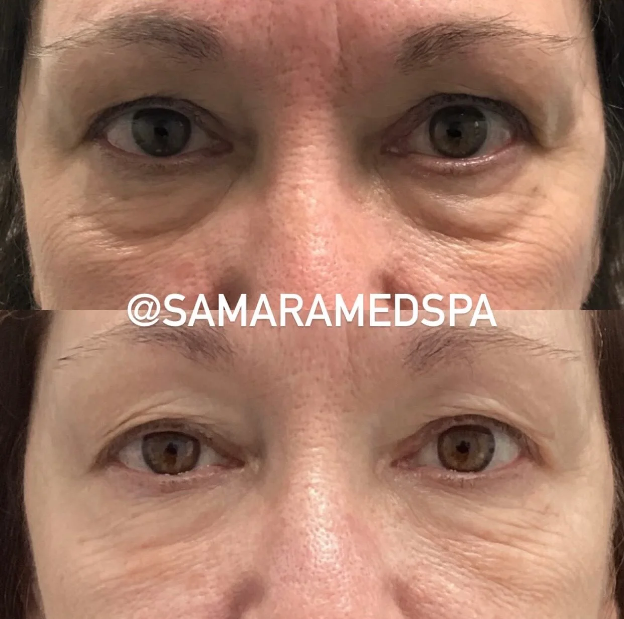 Skin Treatment Before and Ater Samaramedspa