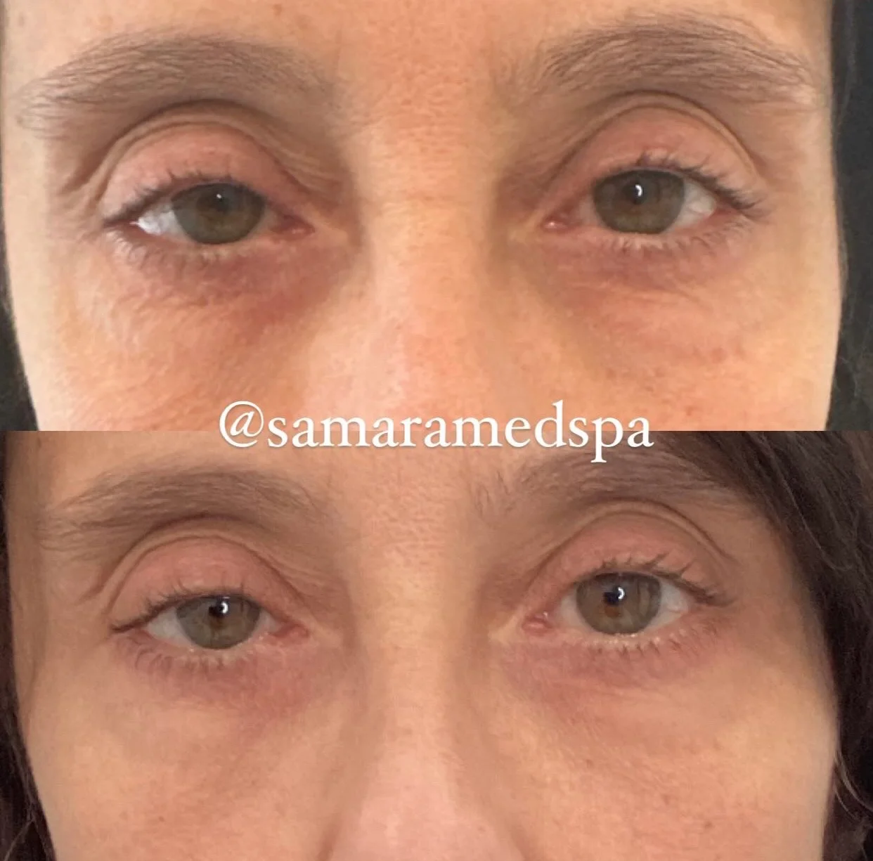 Eye Treatment Before and After