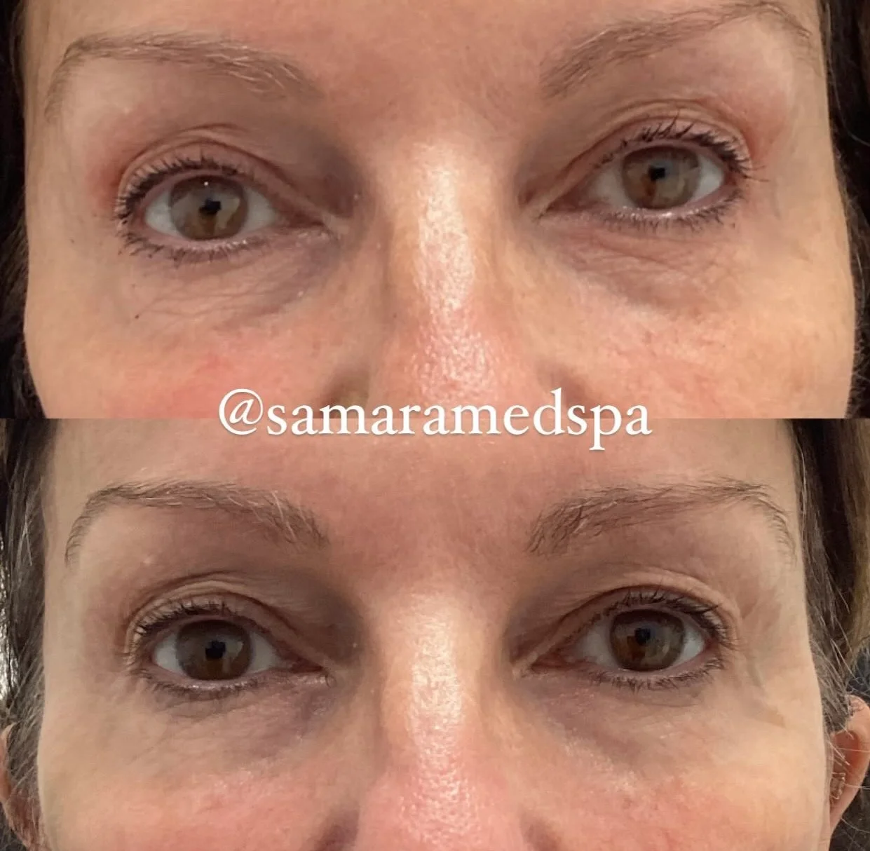 Before and After Skin Treatment Samara