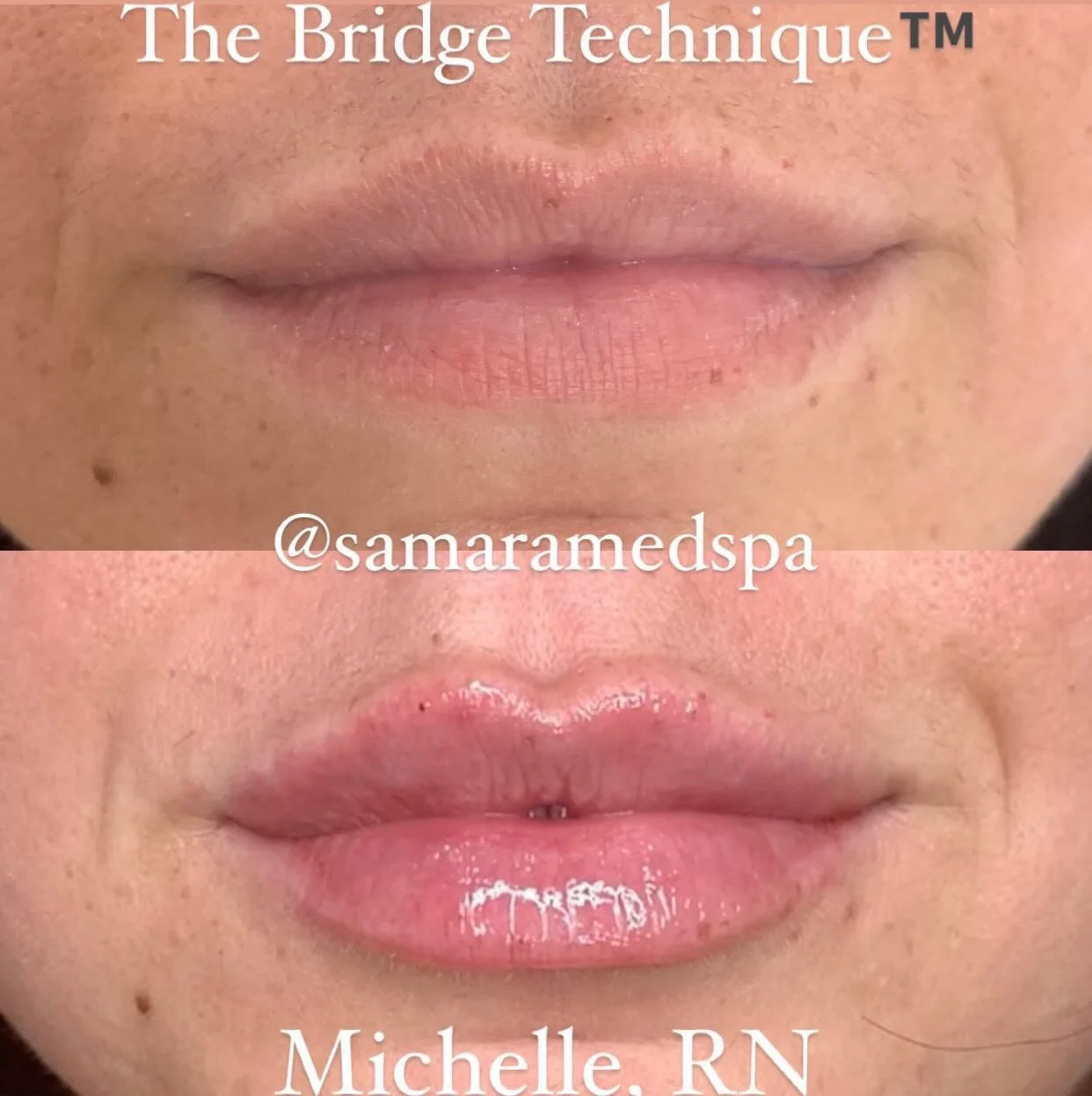 Lip Treatment Michelle
