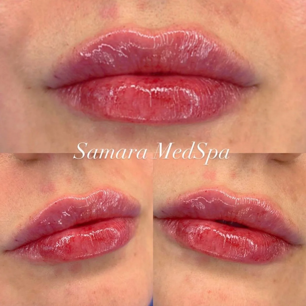 Samara Lip Treatment
