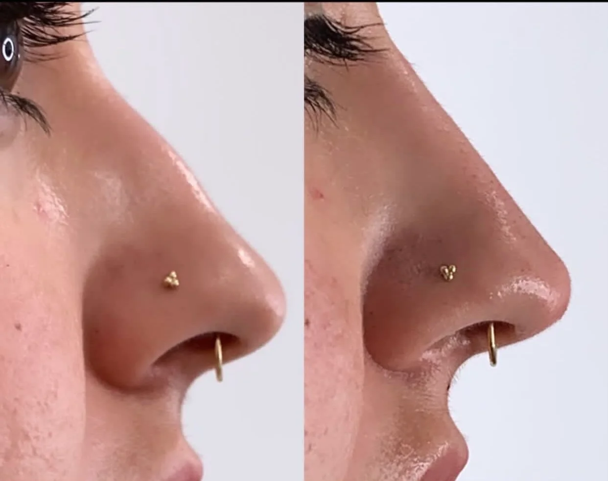 Before and After Samara Treatment