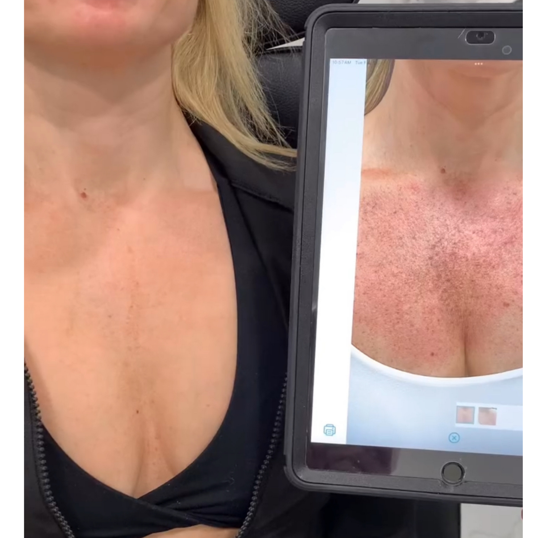 Skin treatment