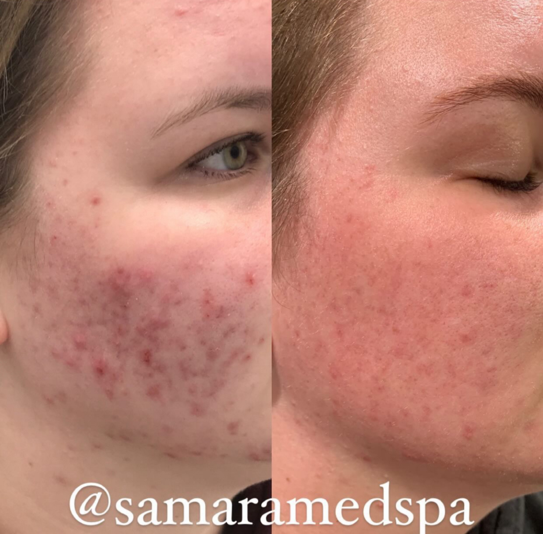 Before and After Skin treatment