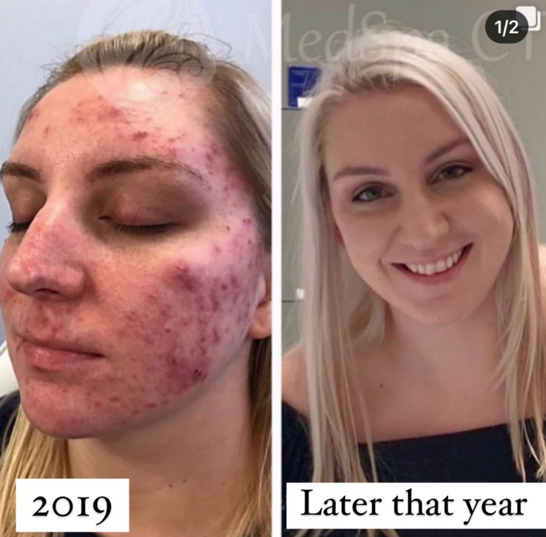 Before and After Skin Change