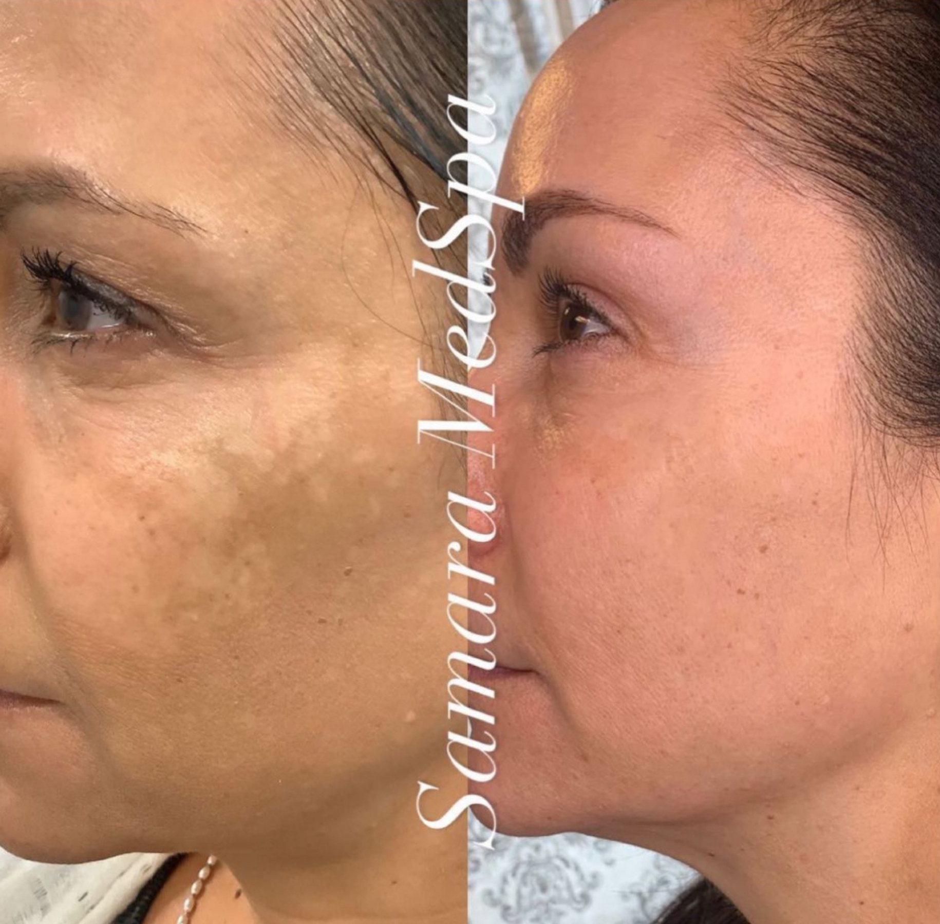Clear Skin Before and After