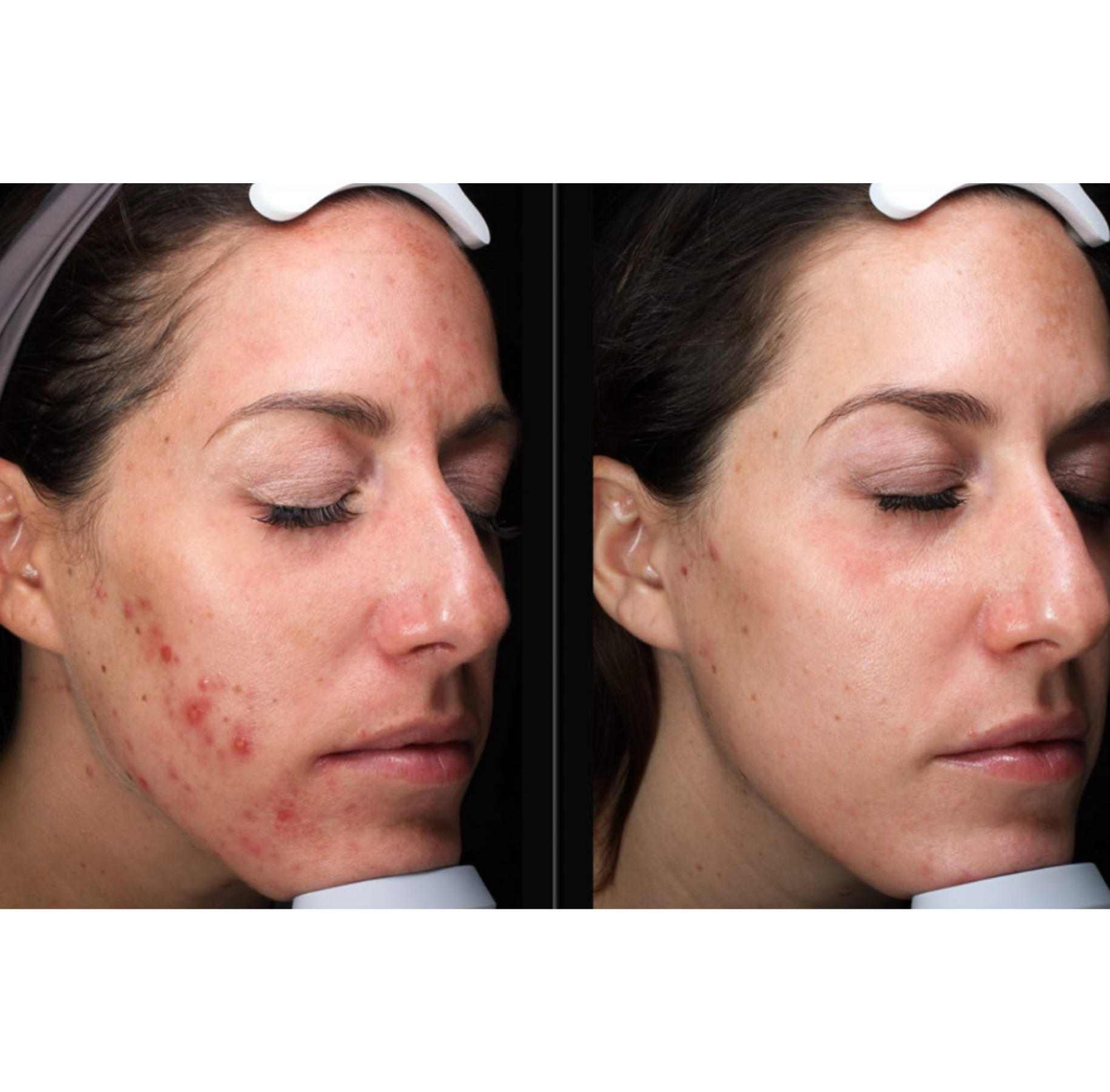 Ficial Skin Treatment