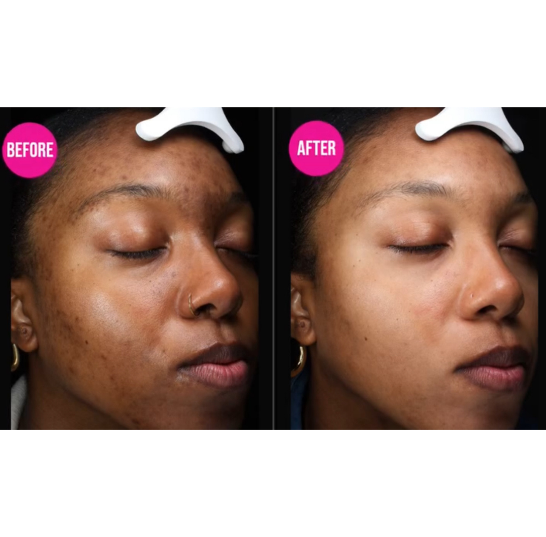 Before and After Samara Treatment