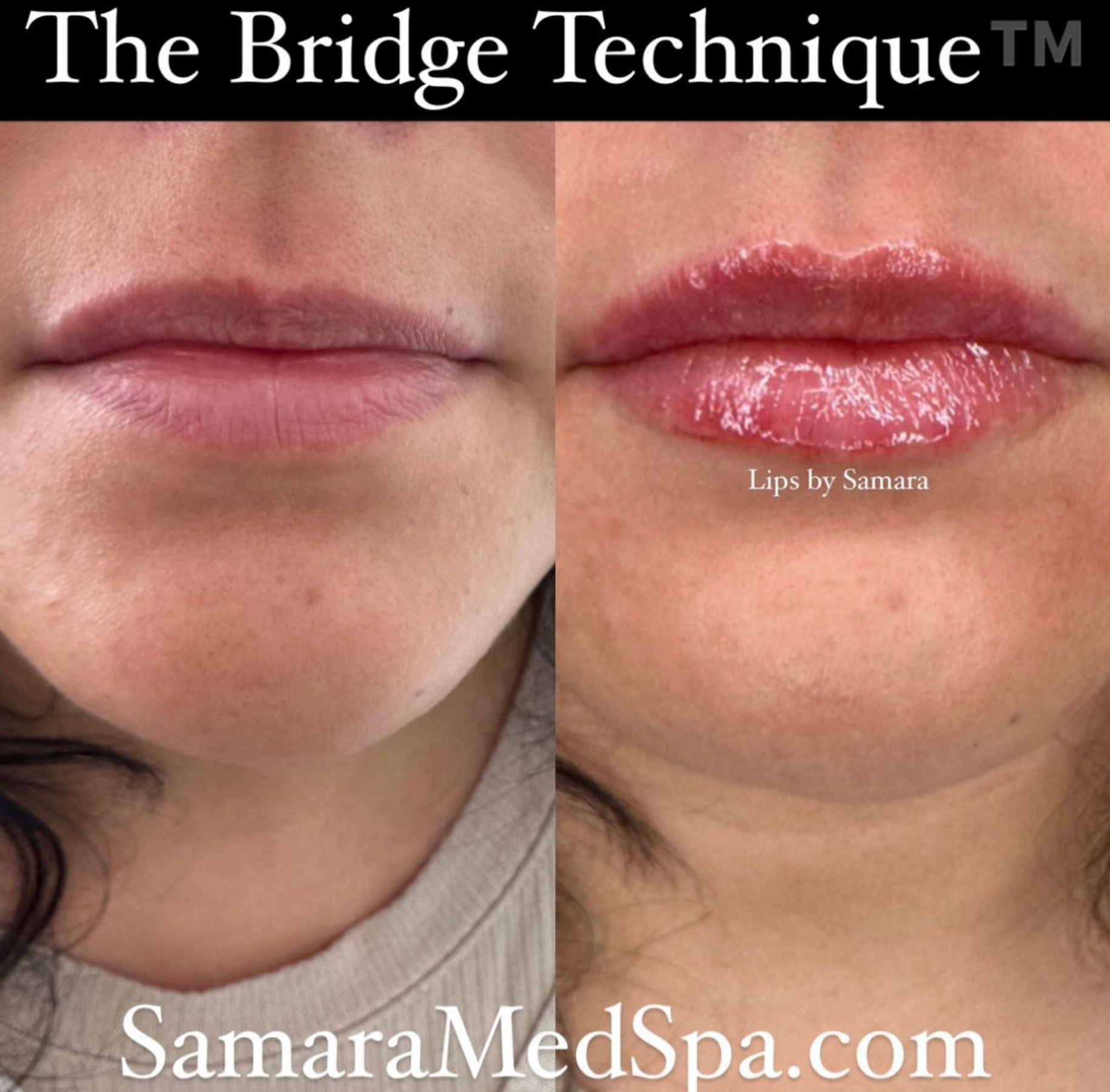 The Bridge Technique