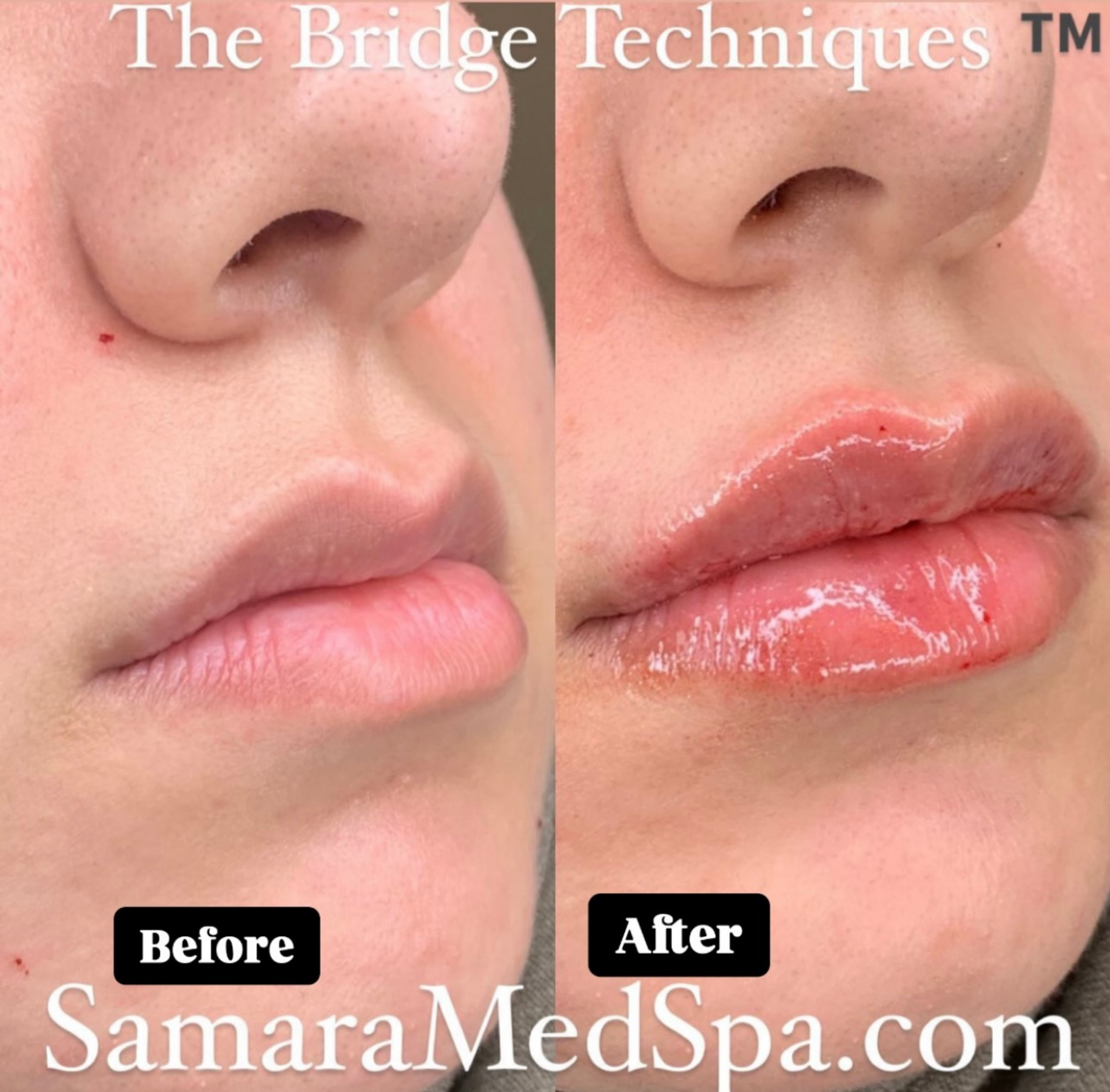 Before and After Bridge