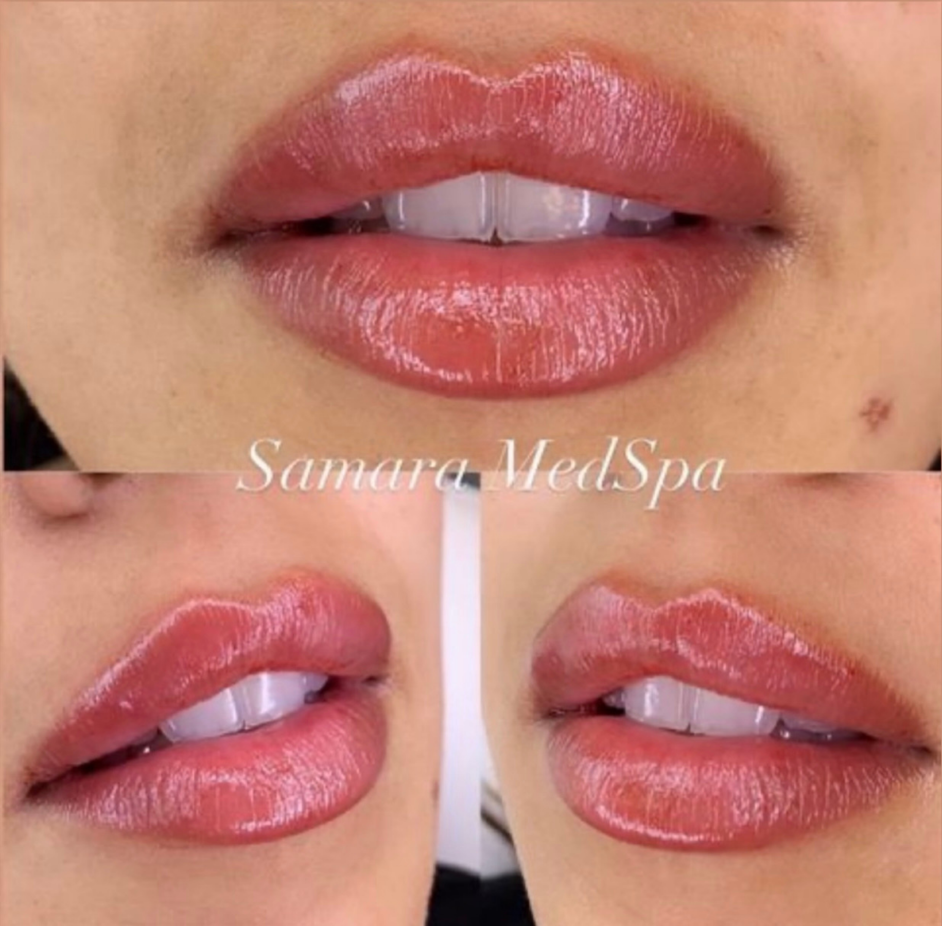 Samara Lip Treatment