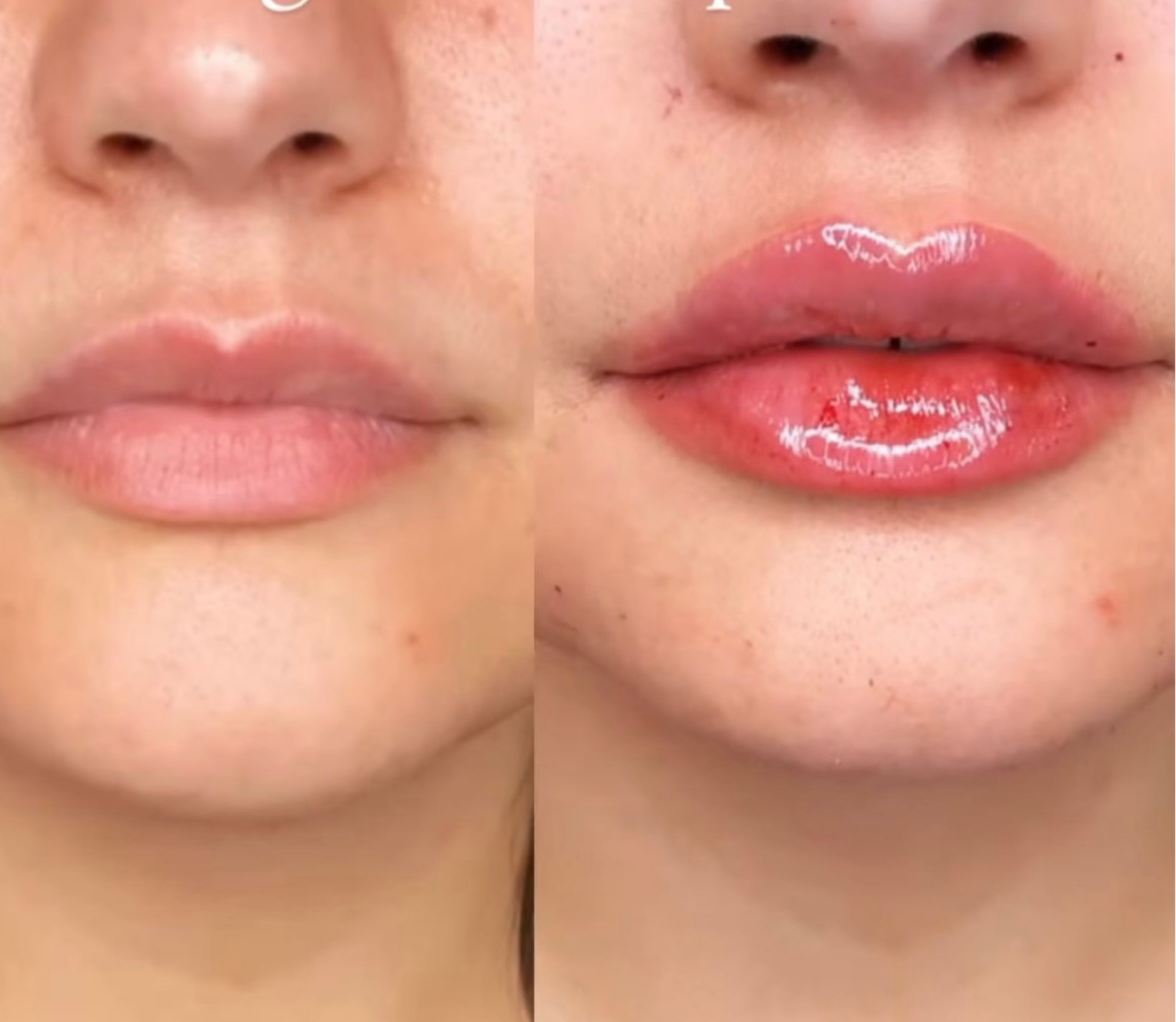 Lip Treatment