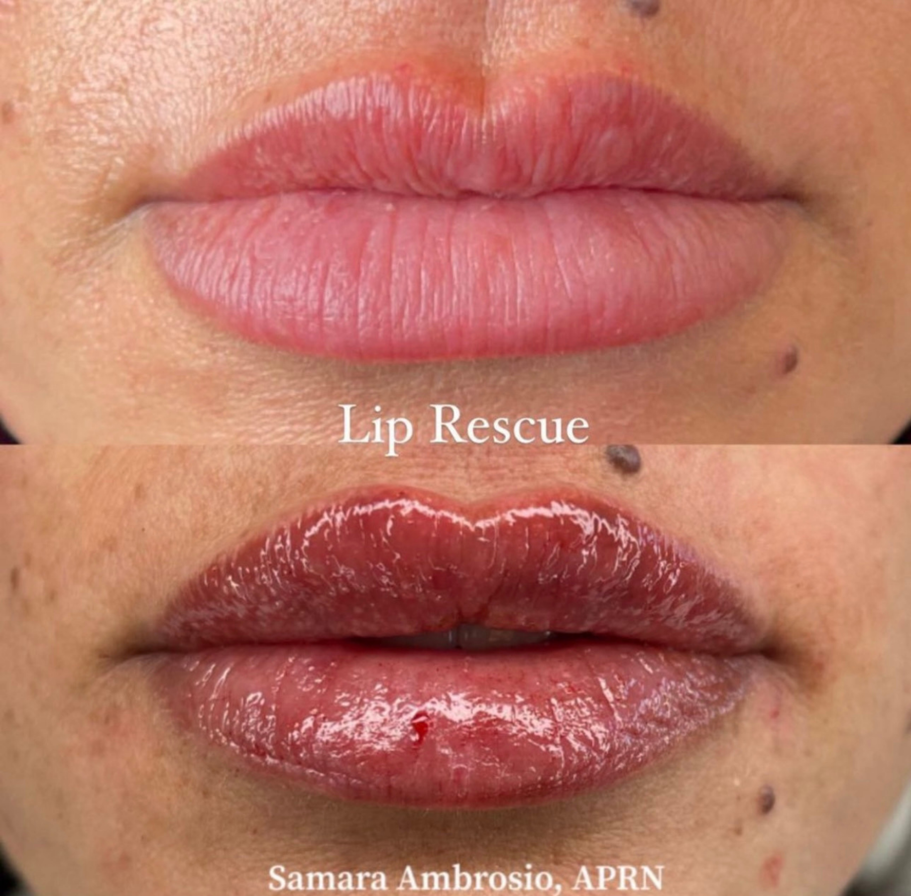 Lip Rescue