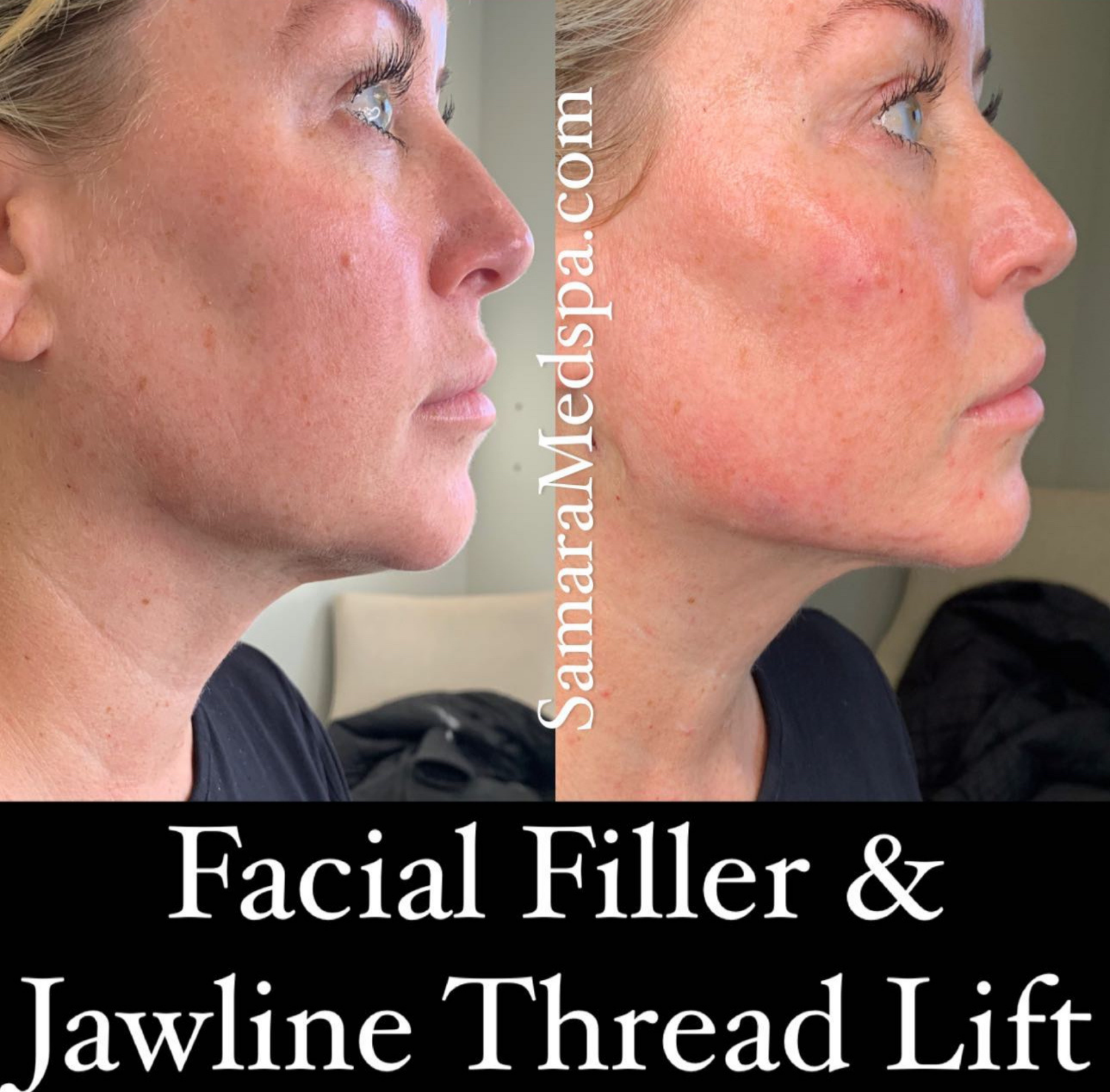 Facial Filler & Jawline Thread Lift