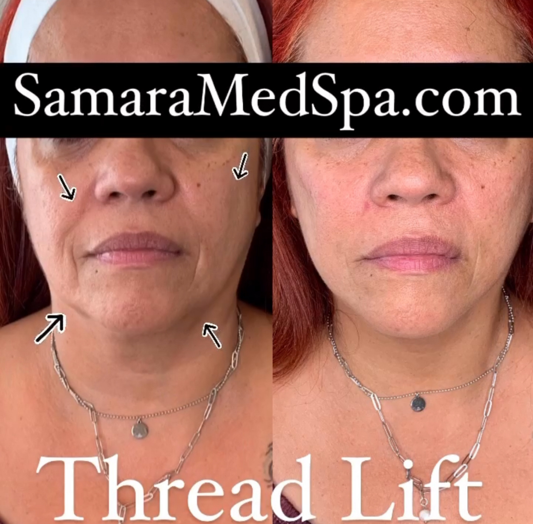 Thread Lift Samara