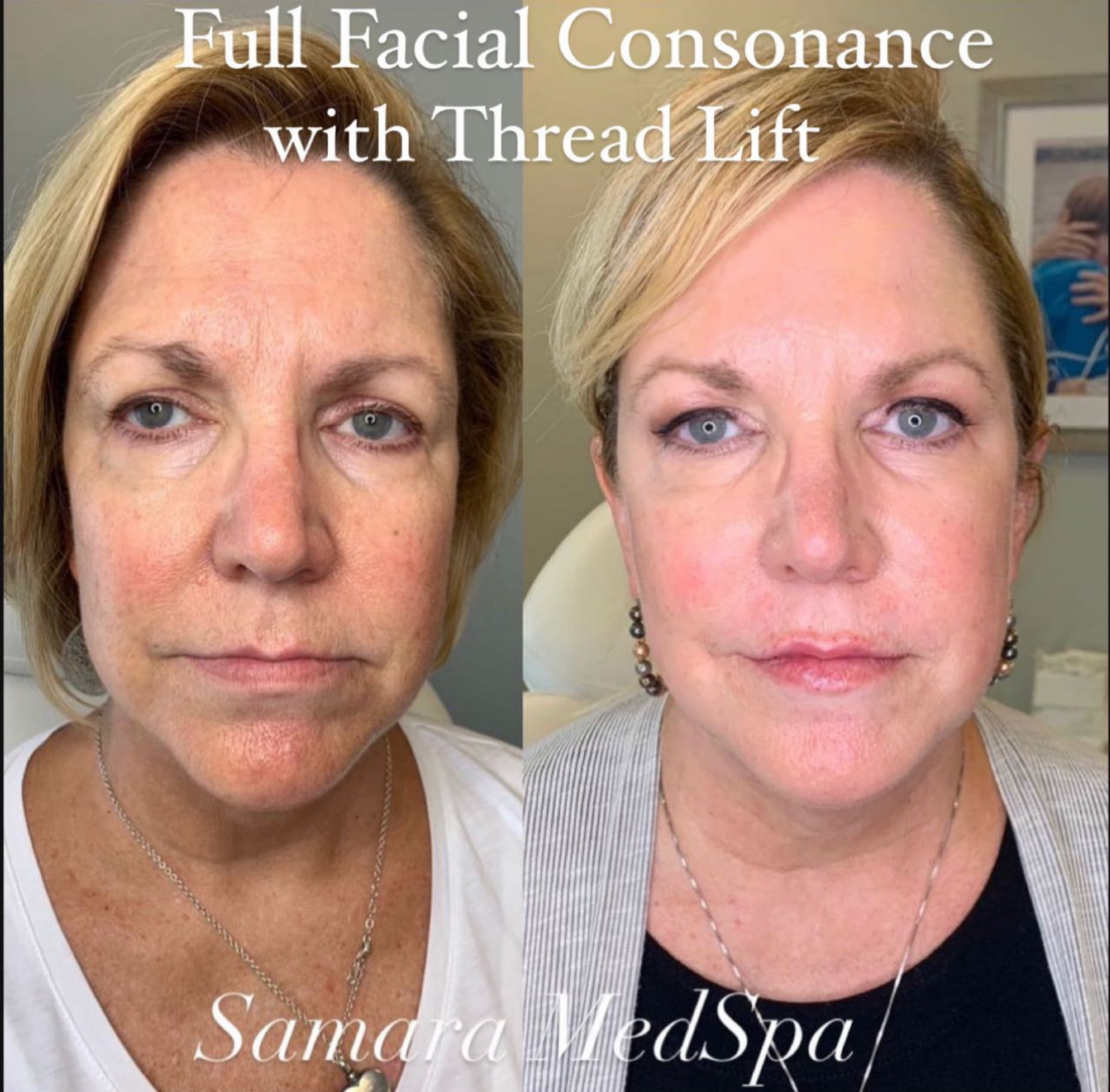 Full Facial Consonance