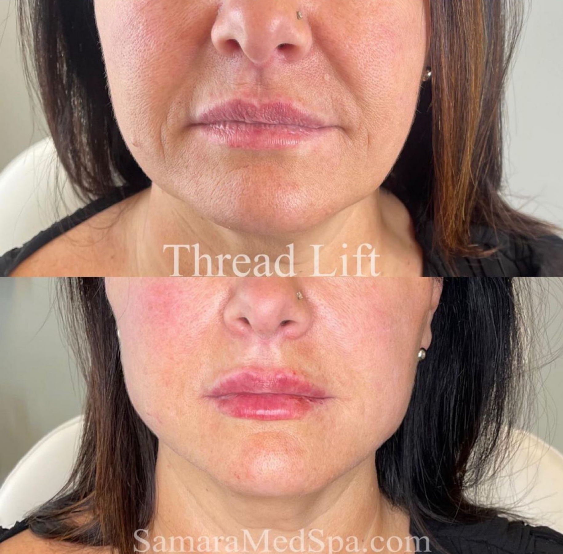 Samara Thread Lift