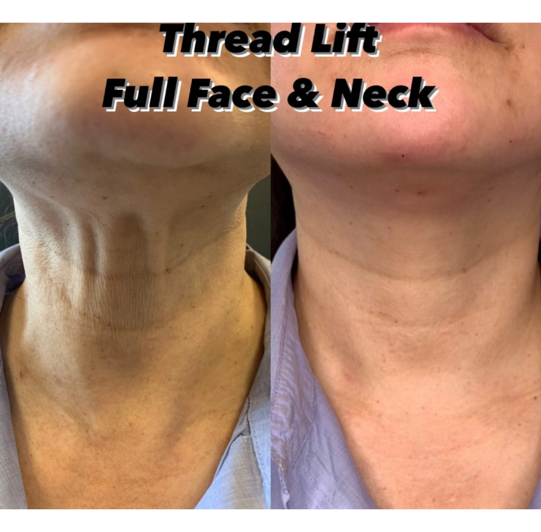 Thread Lift