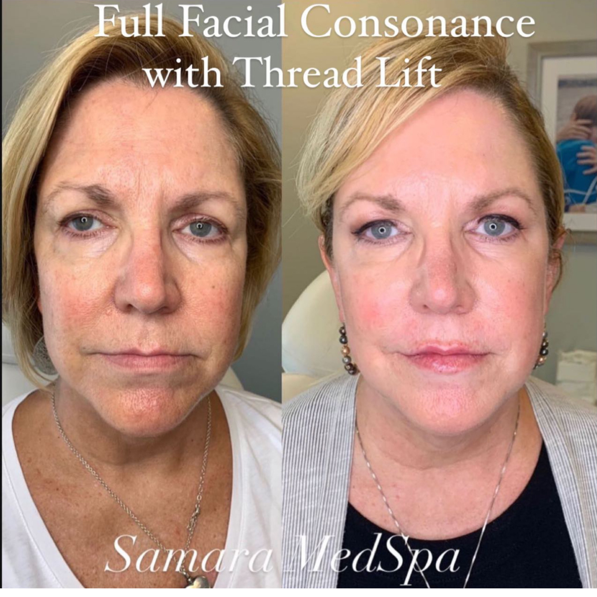 Facial Consonance With Thread Lift