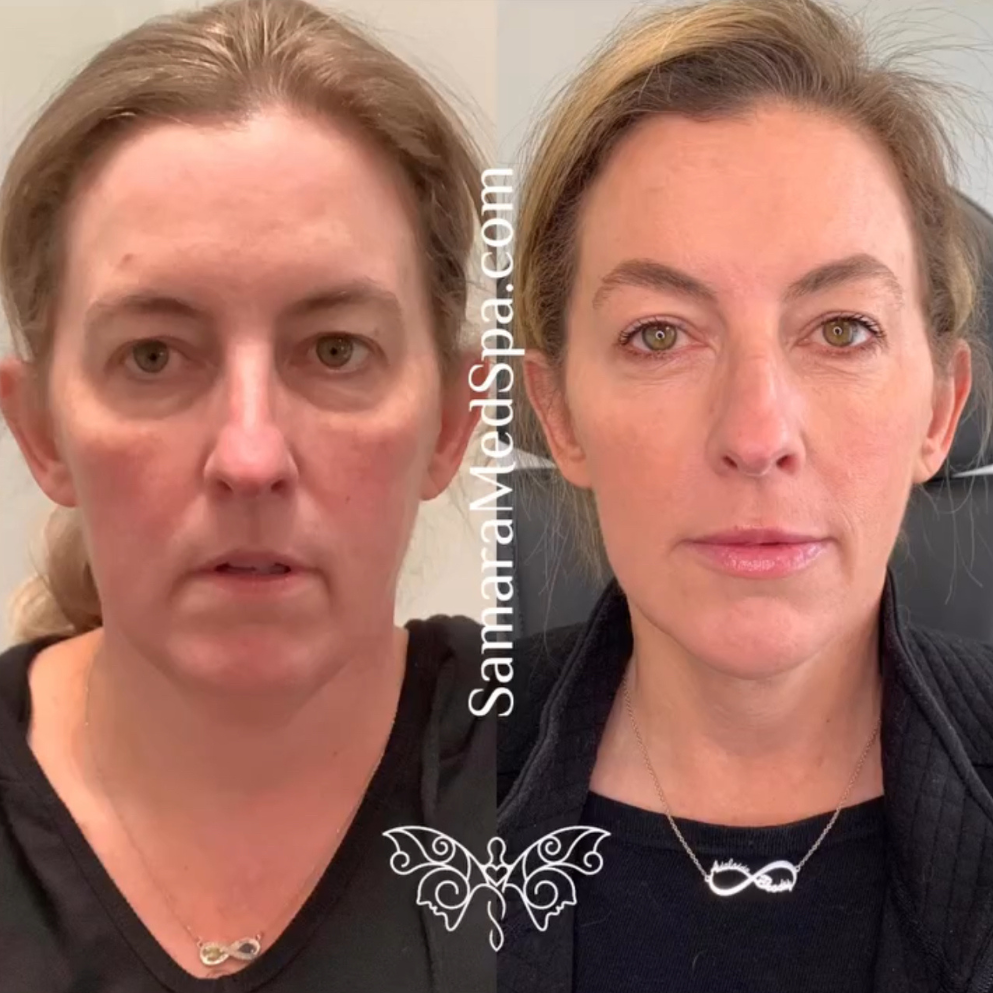 Samara Medspa Before and after