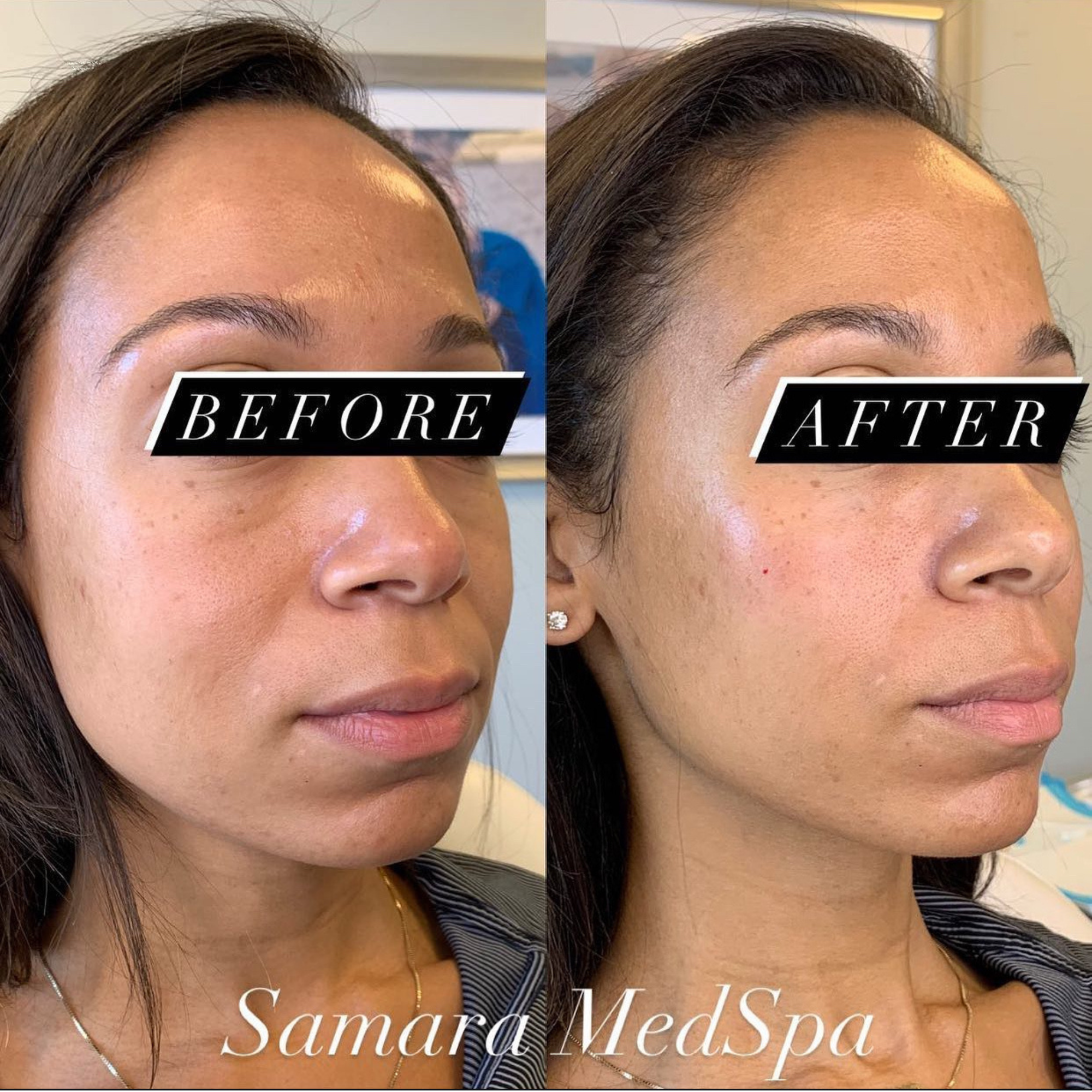 Before and After Samara Medspa