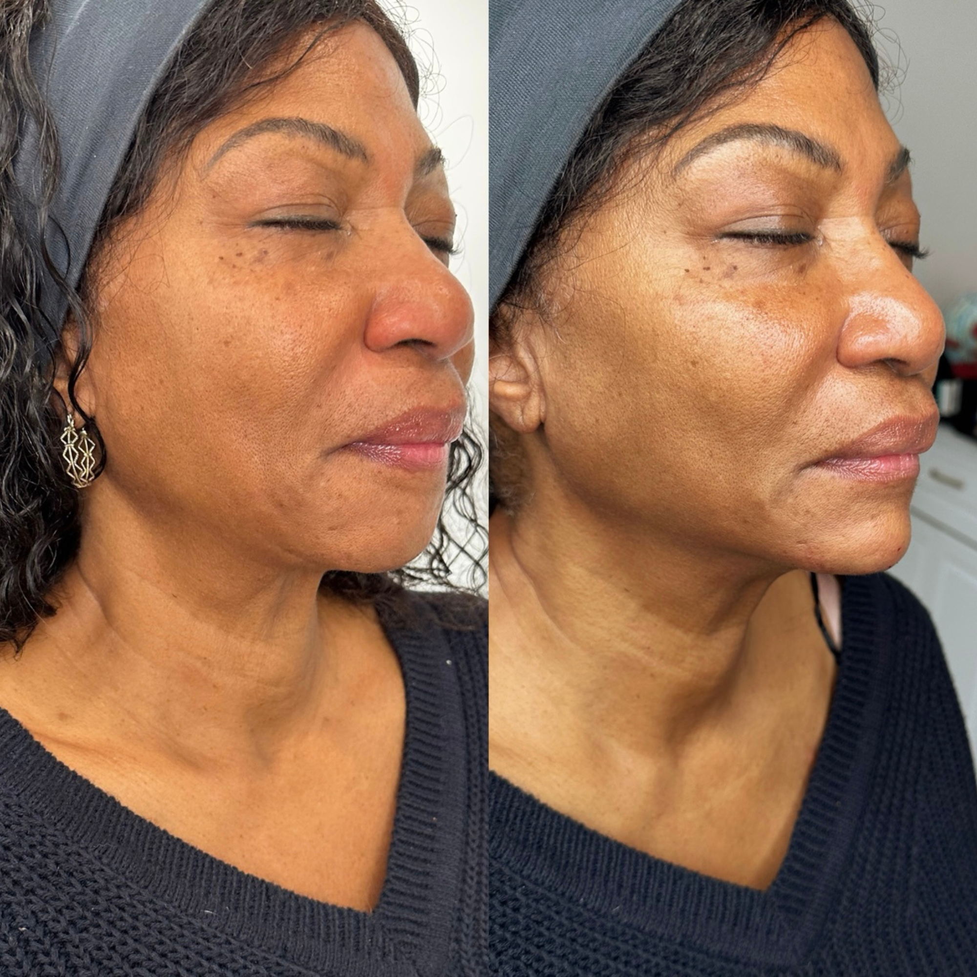 Face Treatment