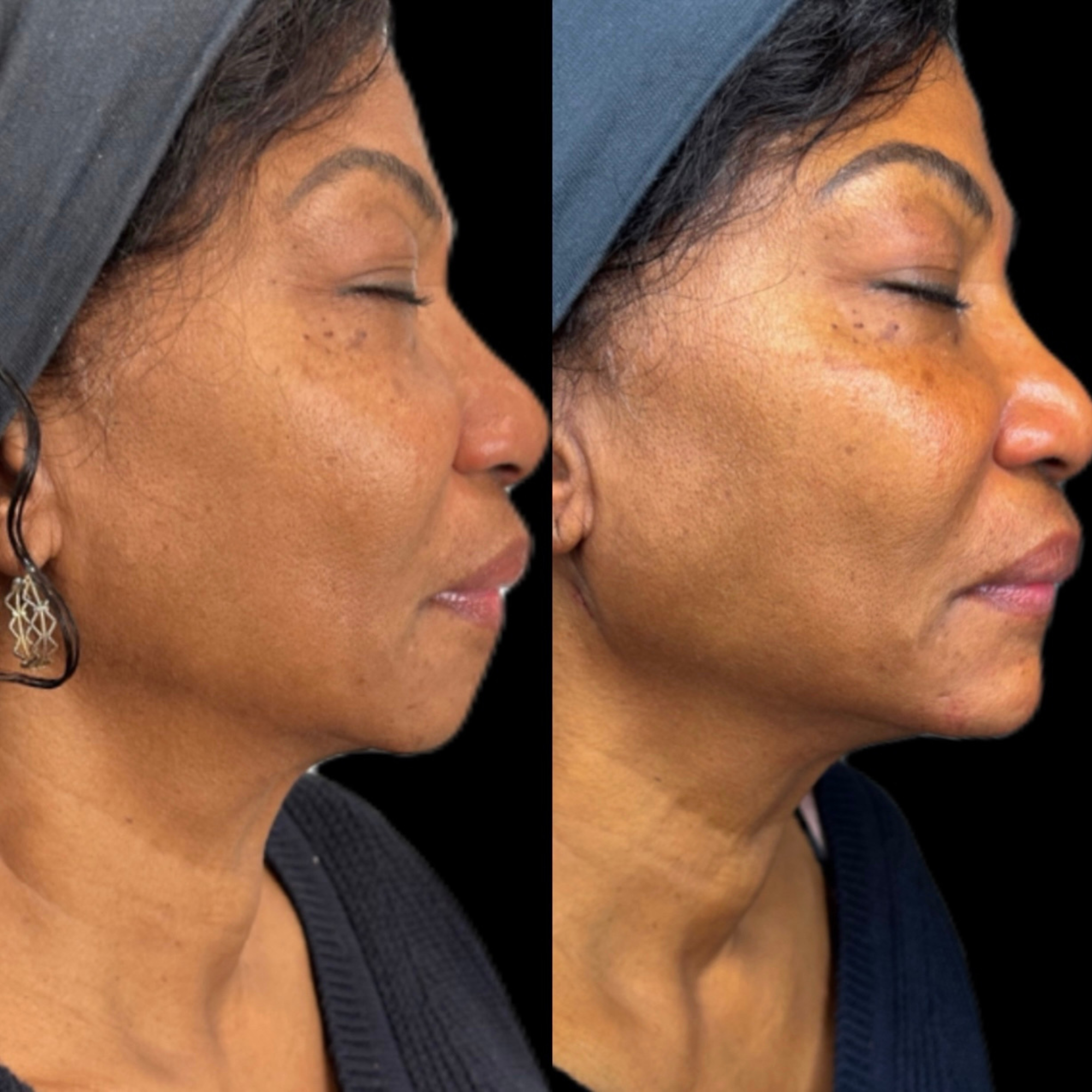 Face Treatment Before and After