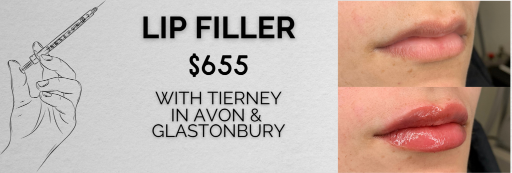 Before & After Lip Filler