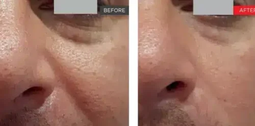 4D Laser Facelift Before and After
