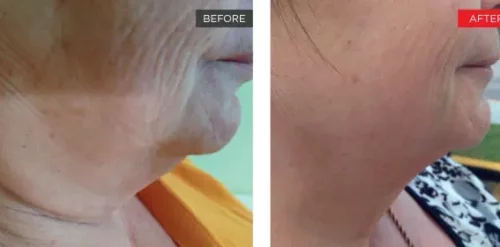 4D Laser Facelift Before and After