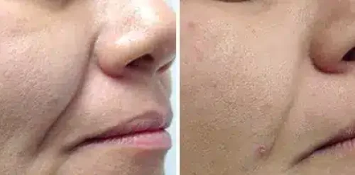 4D Laser Facelift Before and After