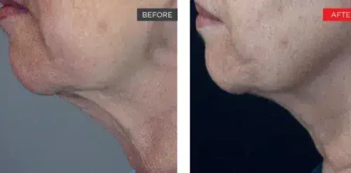 4D Laser Facelift Before and After