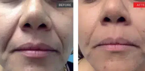 4D Laser Facelift Before and After