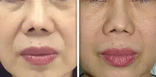 4D Laser Facelift Before and After